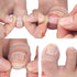 Silicone Ingrown Toenail Corrector, Treatment Tool for Nail Care, 1 Pair for Pedicure Recovery