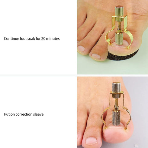 Ingrown Toenail Lifter, Stainless Steel Nail Corrector Tool for Curved Ingrown Toenails, Foot Care Pedicure Tool (Gold)