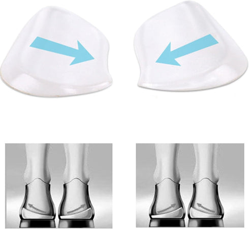 MARS WELLNESS Medial & Lateral Heel Wedge Silicone - 2 Pairs Universal Adhesive Shoe Insert for Knock Knee Pain, Foot