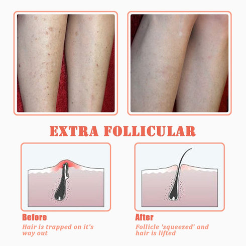 TailaiMei Exfoliating Brush for Ingrown Hair Treatment, Razor Bumps Solution for Men and Women, Orange