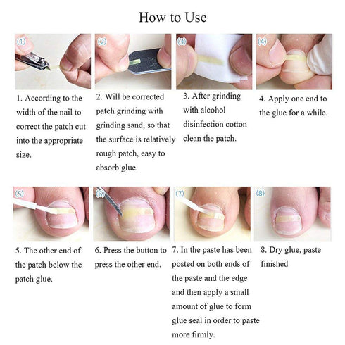 Ingrown Toenail Corrector Strips Brace - 10pcs/bottle - Straightener Clip for Thick Toenails