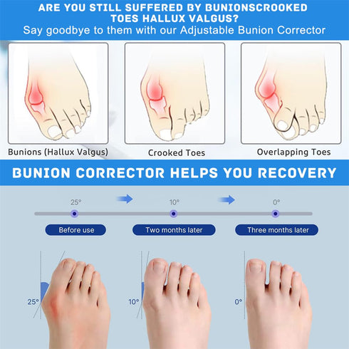 Bunion Corrector Women Men Big Toe, Adjustable Orthopedic Bunion Splint 2 Pcs Bunion Pads for Hallux Valgus Pain Relief Non-Slip Toe Straightener
