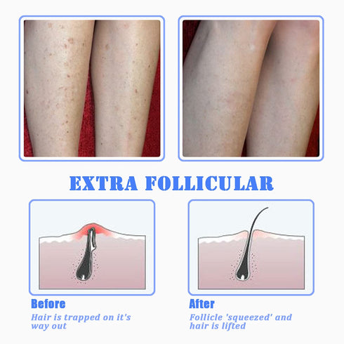 TailaiMei Exfoliating Brush for Ingrown Hair Treatment - Prevent Bikini Bumps, Razor Bumps, Silky Smooth Skin Solution