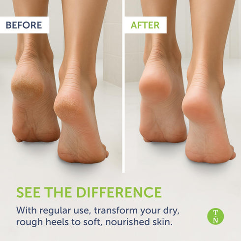 Remedy Balm with Tea Tree Oil, 2 oz - Truremedy Naturals Soothing Moisturizer for Fungal Infections