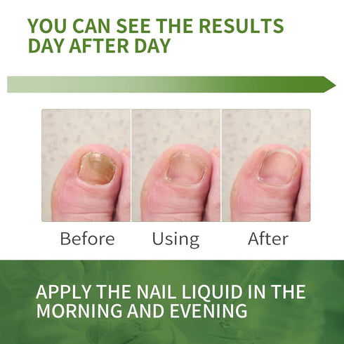 NOXYRAL 7 Toenail Fungus Treatment Extra Strength: Pure Natural Plant ExtractsToe & Fingernail Fungus Renewal - Nail