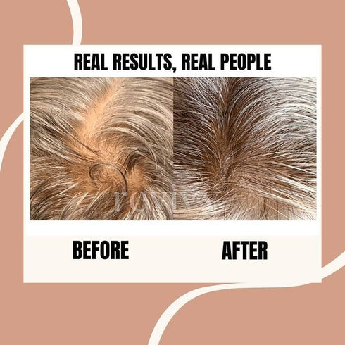 REVIVV Dermaroller Tool for Hair Rejuvenation | Hair Follicle Stimulator | Beard Kit | 0.25mm Micro Needle for Scalp