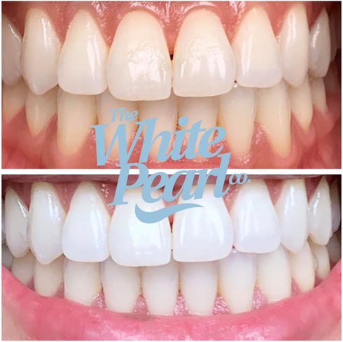 The White Pearl Co 35% Teeth Whitening Kit with LED Light, Wireless, Carbamide Peroxide, Desensitizing Agent, Enamel