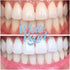 The White Pearl Co 35% Teeth Whitening Kit with LED Light, Wireless, Carbamide Peroxide, Desensitizing Agent, Enamel
