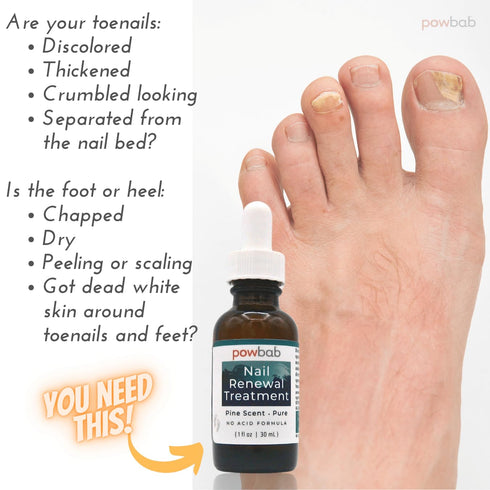 Nail Renewal Treatment for Toenail - Pine Needle Scent, No Acid Formula, 100% Natural Extra Strength Solution