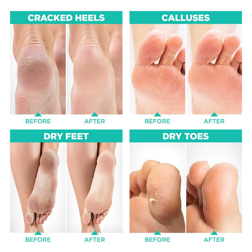 Lavinso Foot Peel Mask for Dry Cracked Feet, 2 Pack Peeling Mask for Soft Baby Feet, Original Scent