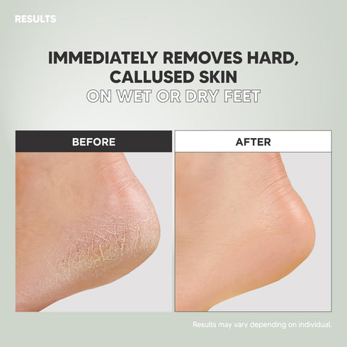 S-Line Emery Foot File, Double-Sided Pedicure Tool for Cracked Heels, Ergonomic Design