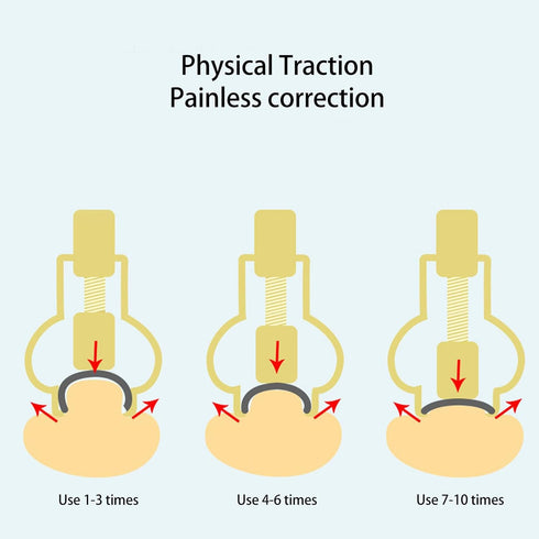 Ingrown Toenail Lifter, Stainless Steel Nail Corrector Tool for Curved Ingrown Toenails, Foot Care Pedicure Tool (Gold)