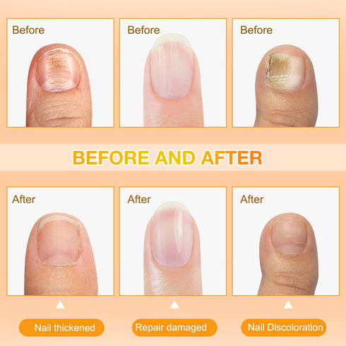 Plresen 0.68 Oz (2PCS) Bee Venom Nail Soothing Spray, Toe Nail Treatments for Damaged Nails, Nail care, Safely