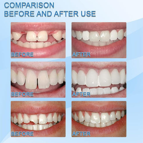 Tooth Repair Kit, Teeth Replacement Kit for Temporary Restoration of Missing & Broken Teeth Replacement Dentures