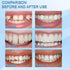 Tooth Repair Kit, Teeth Replacement Kit for Temporary Restoration of Missing & Broken Teeth Replacement Dentures