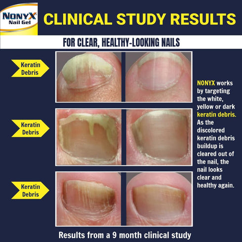 Nail Clarifying Gel, Clinically Proven for Discolored and Damaged Toenails, Effective Treatment