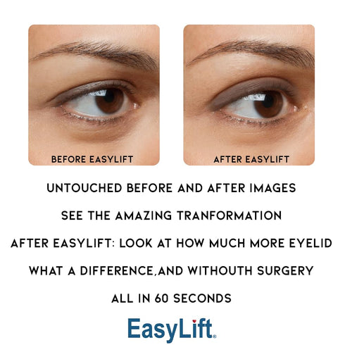 Original Eye Lift Kit, Small/Medium Size with Gel, Lifts Eyelid Droop and Hooded Eyes