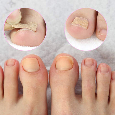 Ingrown Toenail Correction Patch, 50 Pcs Glue-free Stickers for Professional Foot Care