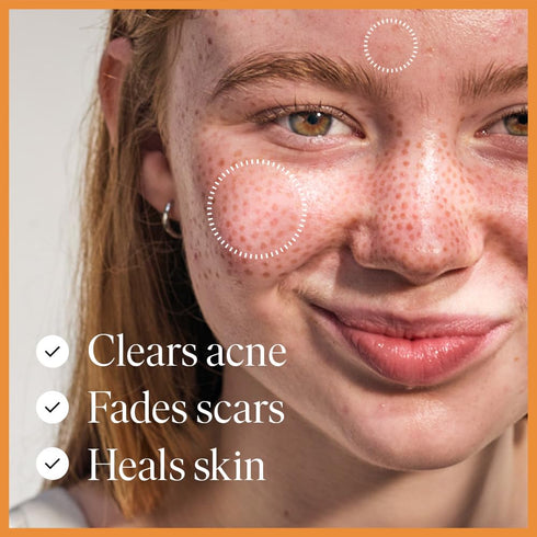 Hydrating Face Serum for Clearing Acne & Scars, Anti-Blemish & Scar Repair Serum for All Skin Types (1.01 oz)