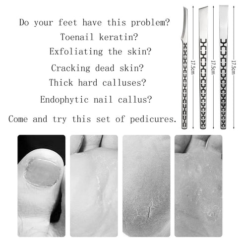 Stainless Steel Ingrown Toenail Pedicure Knife Set,Professional Foot Skin Scraper Repair Sharp Blade Kit For Nail Corn Callus Paronychia Treatment. (1)