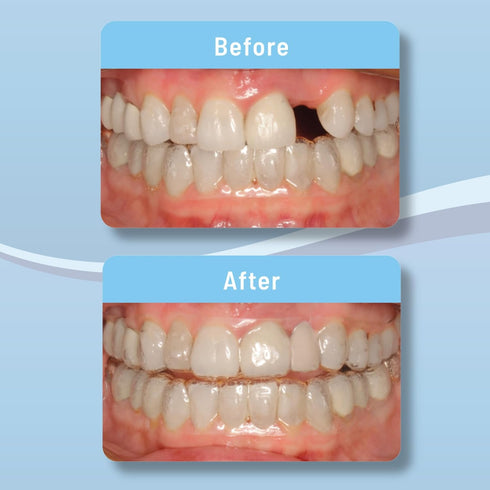Aligner Pontics | Temporary Tooth Replacement for Aligner Trays and Retainers (16 Count) During Orthodontic Treatment