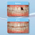 Aligner Pontics | Temporary Tooth Replacement for Aligner Trays and Retainers (16 Count) During Orthodontic Treatment