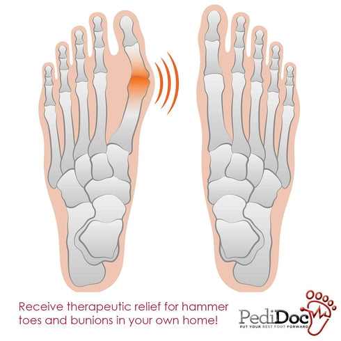 Bunion Corrector Big Toe Strap – Bunion Relief Toe Straightener, Restores Natural Alignment of Overlapping Toes
