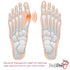Bunion Corrector Big Toe Strap – Bunion Relief Toe Straightener, Restores Natural Alignment of Overlapping Toes