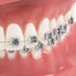 TM-208 Demonstration Orthodontic Model Teeth with Metal and Ceramic Bracket (Red)