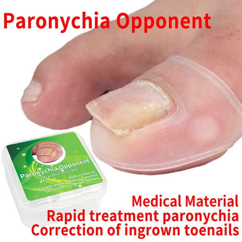 Ingrown Toenail Corrector, Silicone Ingrowing Nail Corrector, Ingrown Toenail Correction Treatment, Toe Nail Care Fingernail Care Tool, Pedicure Paronychia Recovering Tool, 1 Pair