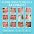 Renewal Complex Acne Moisturizer for Face, Back & Body, Professional Grade AHA + BHA Cream with 2% Mandelic Acid