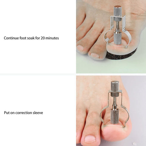 Ingrown Toenail Lifter Tool, Stainless Steel Clamp for Ingrown Toenail Care, Professional Foot Care Tool, Silver