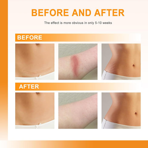 Silicone Scar Sheets, 1" x 60" Roll, Soft Silicone Tape for Scars Removal, Painless for Surgery, C-section, Burn