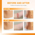 Silicone Scar Sheets, 1" x 60" Roll, Soft Silicone Tape for Scars Removal, Painless for Surgery, C-section, Burn