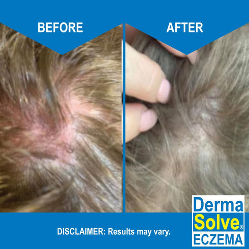 Pack) Eczema Shampoo & Conditioner (Combo - Flare Control Scalp & flake Relief Therapy that Protects, Moisturizes