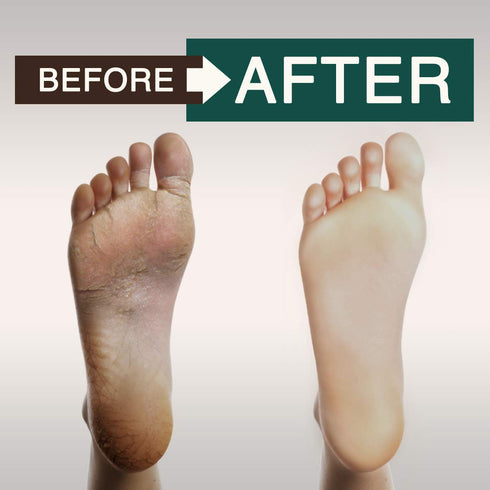 Tea Tree Oil Body Wash - Helps with Athletes Foot, Acne, Eczema, 16oz, Moisturizing Aloe