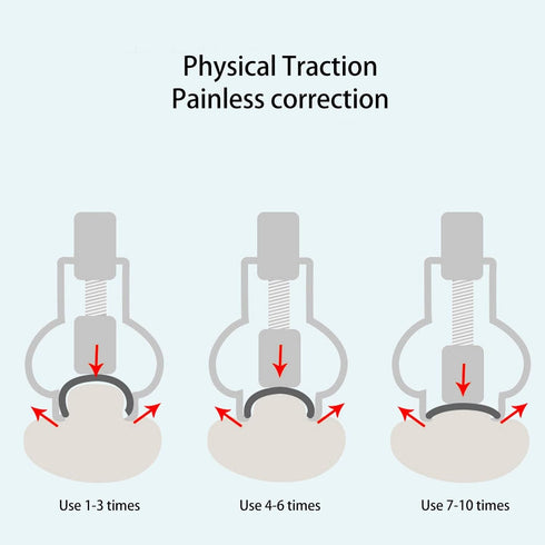 Ingrown Toenail Lifter Foot Care Tool Toenail Clamp Stainless Steel Ingrown Toenail Tools Stainless Steel Professional For Paronychia, Ingrown Toenail Clamp (Silver)