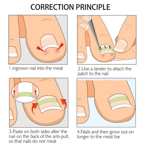Ingrown Toenail Corrector Strips Brace - 10pcs/bottle - Straightener Clip for Thick Toenails