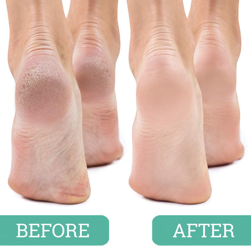 Maccibelle Foot Pumice and Scrubber for Feet and Heels, 3 Pack, Safely Eliminate Callus and Dead Skin