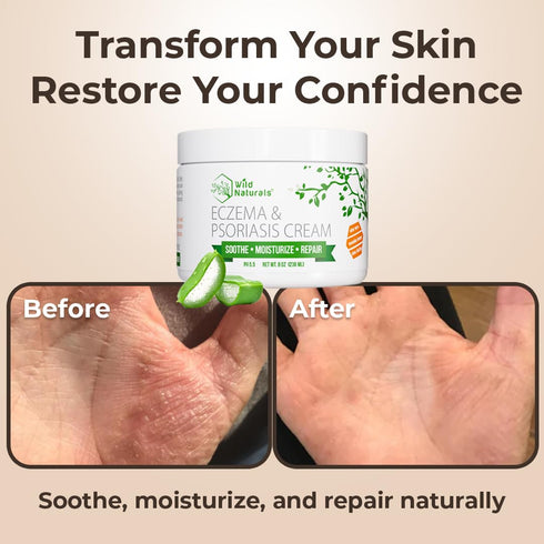 Wild Naturals Eczema & Psoriasis Cream for Dry, Itchy Skin Eczema Relief for Adults & Kids Moisturizing Psoriasis Cream