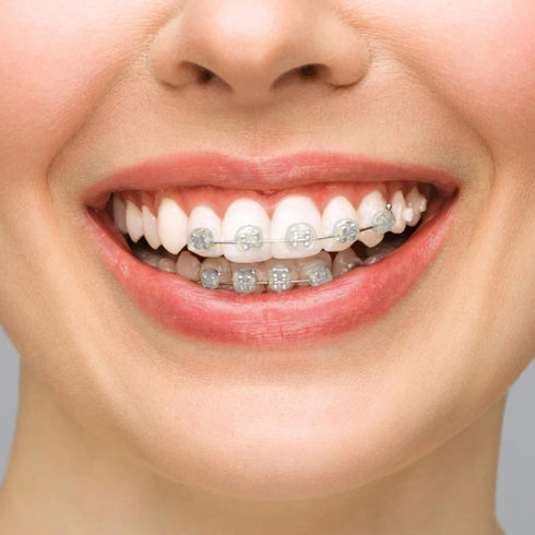 BVN Braces Wax Dental Wax, 10 Boxes Orthodontic Wax Strips, Relief Wax for Braces Wearers