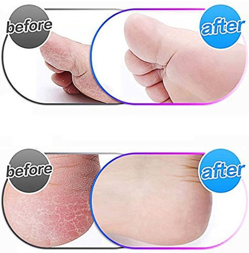 MOVELOVE 8 Pack Blue Replacement Roller Compatible with Scholl Express Pedi Foot Smoother-Extra Coarse