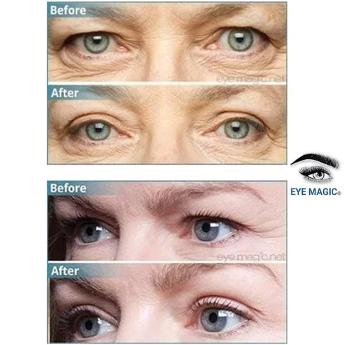Original Eye Lift Kit, Small/Medium Size with Gel, Lifts Eyelid Droop and Hooded Eyes