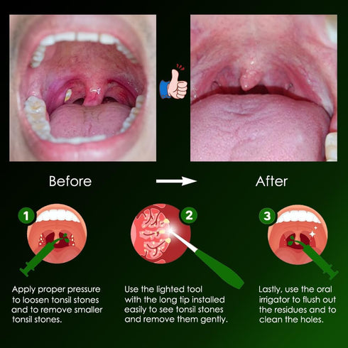 Airgoesin Upgraded Tonsil Stone Remove Tool + Irrigation Clean Syringe for Fresh Breath