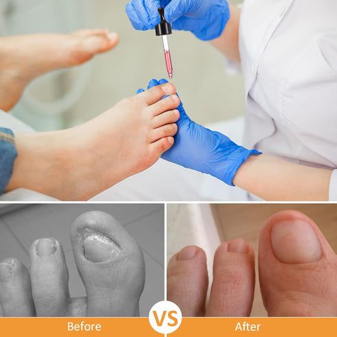 Ingrown Toenail Treatment Kit, Pain Reliever and Softener for Easy Trimming with Silicone Gel Toe Caps