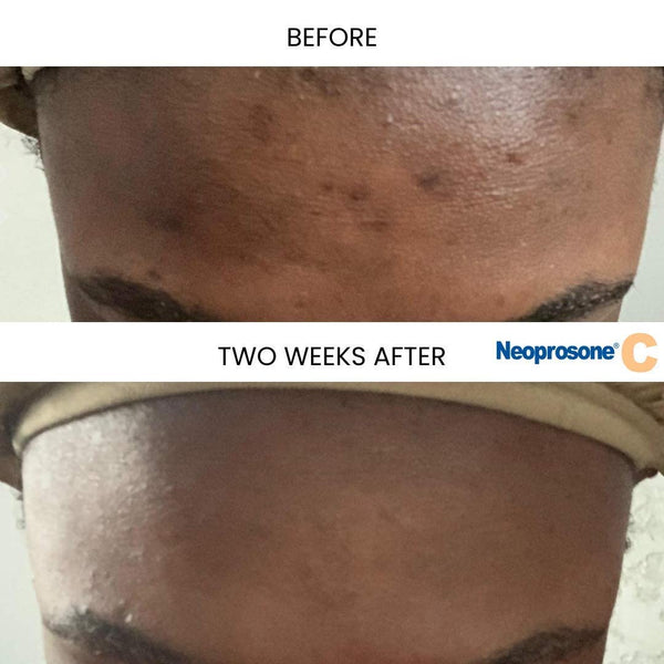 Neoprosone Vitamin C Serum for Face | 1 Fl oz / 30ml | Brightening Serum with Alpha Arbutin and Castor Oil