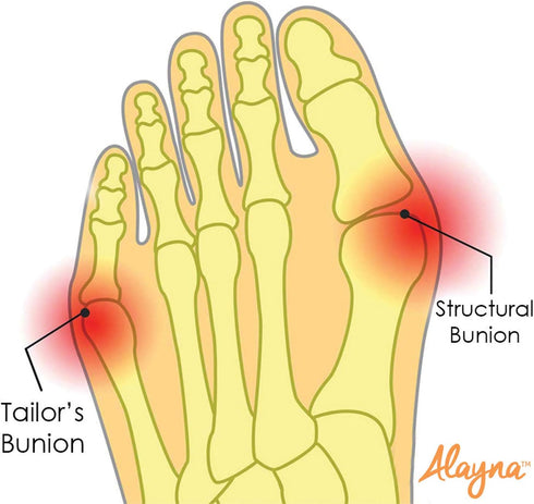 Alayna Bunion Corrector Gel Pad Cushion Splint for Men & Women, Orthopedic Bunion Protector (2 PCS) (Small)