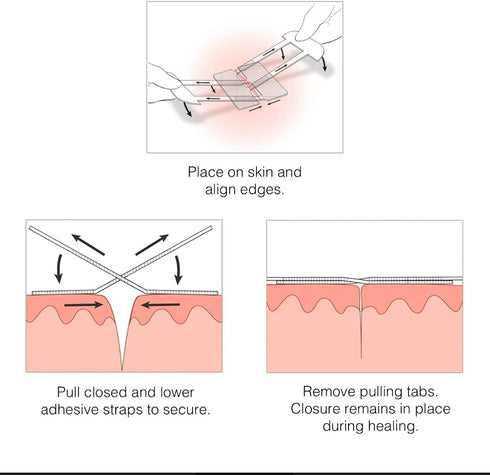 Clozex Emergency Laceration Kit - FDA Cleared Skin Closure Device for Wounds Up to 1.5 Inches