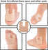 48 Pieces U Shaped Felt Callus Pads, Metatarsal Foot Pads for Pain Relief, Adhesive Pads for Men and Women