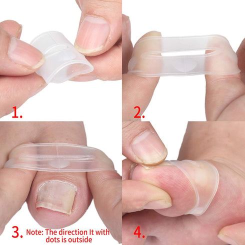 Silicone Ingrown Toenail Corrector, Treatment Tool for Nail Care, 1 Pair for Pedicure Recovery